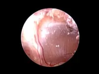 Otitis media dog Left Ear