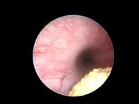 EVR Laparoscopic Cystoscopy